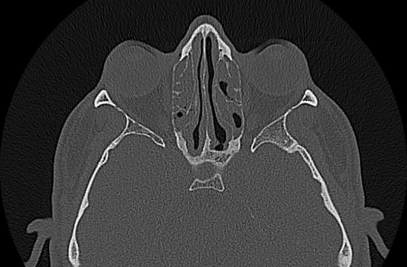 File:Chronic rhinosinusitis (Radiopaedia 65079-74075 Axial bone window 51).jpg