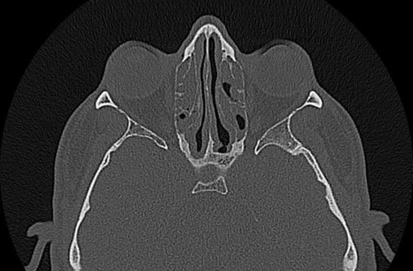 Chronic rhinosinusitis (Radiopaedia 65079-74075 Axial bone window 51).jpg