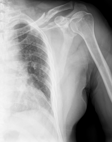 File:Clavicle fracture (Radiopaedia 21744).png