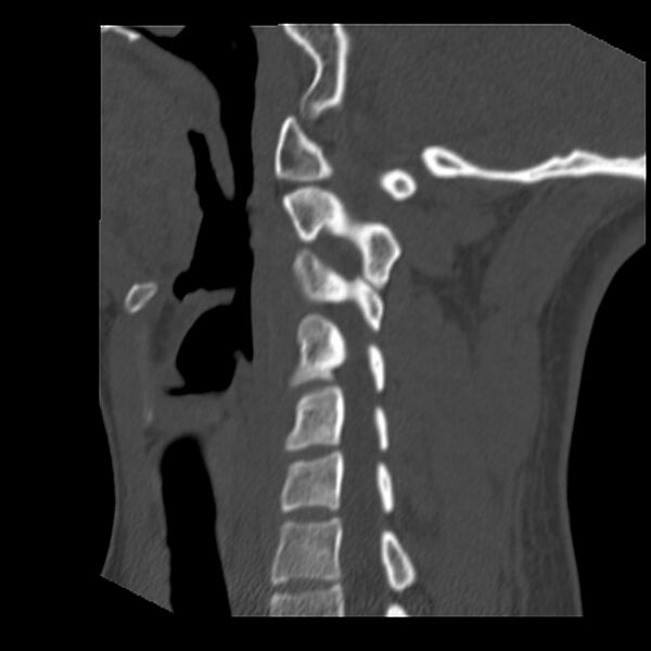File:Clay-shoveler fracture (Radiopaedia 22568-22590 Sagittal bone window 29).jpg