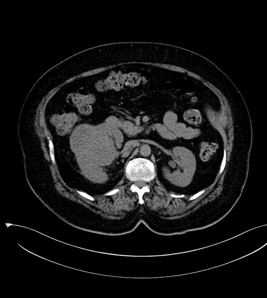 File:Clear cell renal cell carcinoma (Radiopaedia 85004-100537 Axial non-contrast 10).jpg