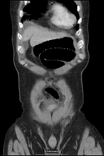 File:Closed loop bowel obstruction and ischemia (Radiopaedia 86959-103180 B 3).jpg