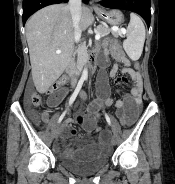 File:Closed loop small bowel obstruction (Radiopaedia 71211-81508 B 54).jpg