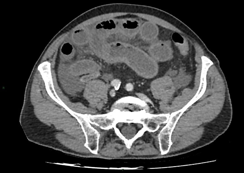 Closed loop small bowel obstruction with ischemia (Radiopaedia 84180-99456 A 85).jpg