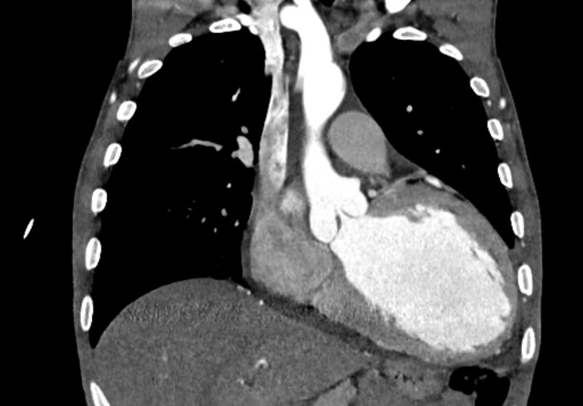 Coarctation of aorta with aortic valve stenosis (Radiopaedia 70463-80574 C 86).jpg