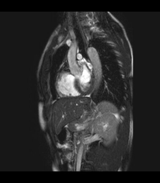 File:Coarctation of the aorta (Radiopaedia 43373-46729 C 15).jpg
