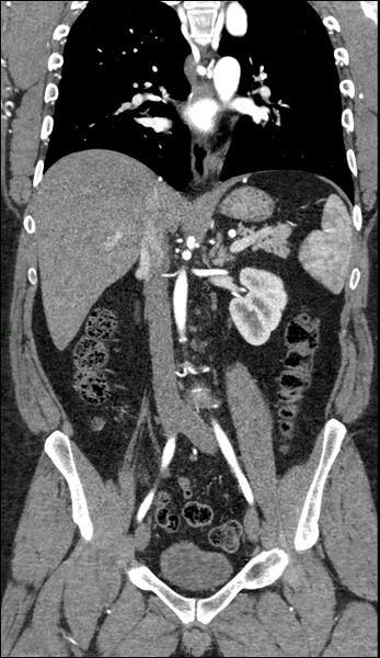 File:Coarctation of the aorta (Radiopaedia 74632-88521 B 130).jpg