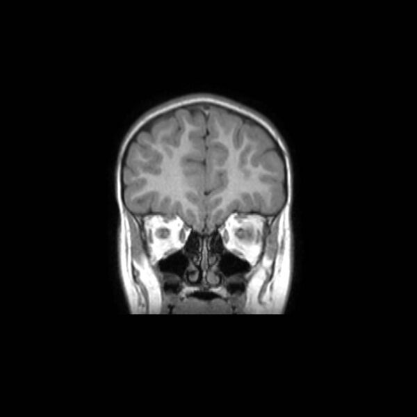 File:Cochlear nerve aplasia - unilateral (Radiopaedia 87910-104413 Coronal T1 12).jpg