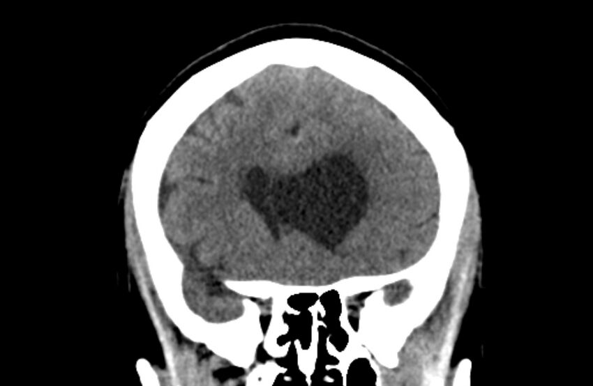 Colloid cyst (Radiopaedia 53180-59146 Coronal non-contrast 23).jpg