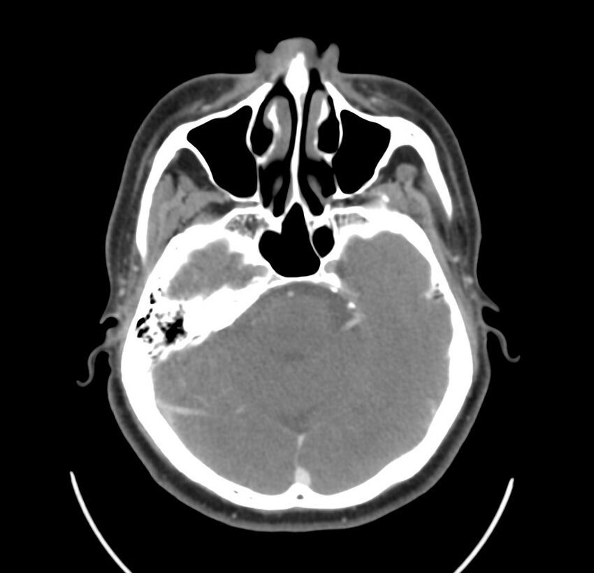 Colloid cyst of thyroid (Radiopaedia 22897-22923 Axial C+ delayed 6).jpg