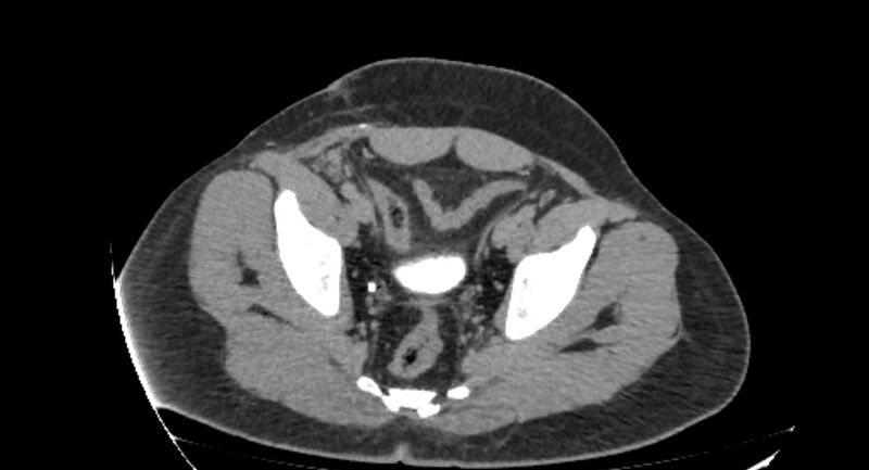 File:Colocutaneous fistula (Radiopaedia 56401-63062 Axial Fistulography 49).jpg