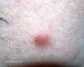 Dermatofibroma (DermNet NZ lesions-dermfib1).jpg