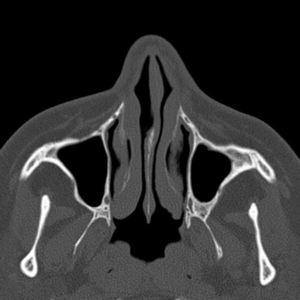 File:Nasolabial cyst (Radiopaedia 33987-35205 Axial bone window 13).jpg