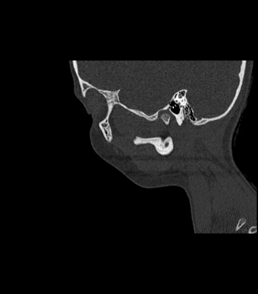 File:Nasoorbitoethmoid fracture (Radiopaedia 90044-107205 Sagittal bone window 35).jpg