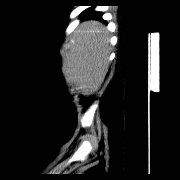 File:Neuroblastoma with skull metastases (Radiopaedia 30326-30960 B 4).jpg