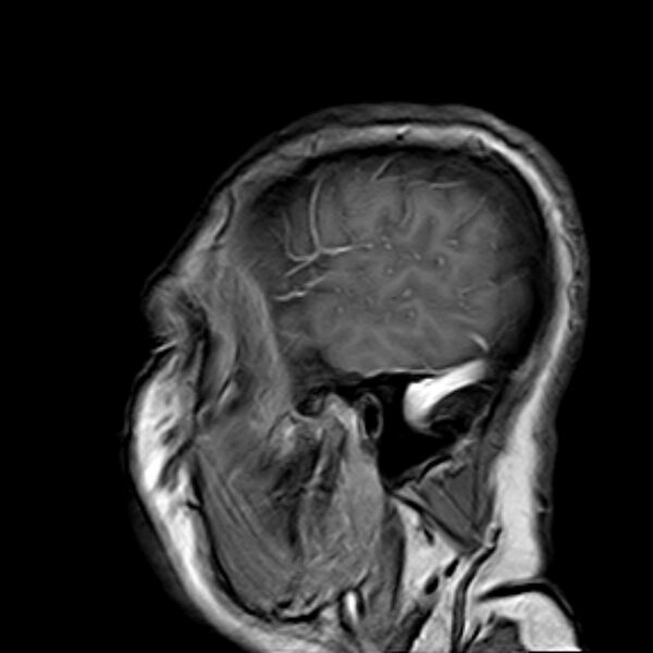 File:Neurofibromatosis type 2 (Radiopaedia 67470-76871 Sagittal T1 C+ 2).jpg