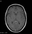 Neurosarcoidosis (Radiopaedia 10930-11351 Axial T1 C+ 10).jpg