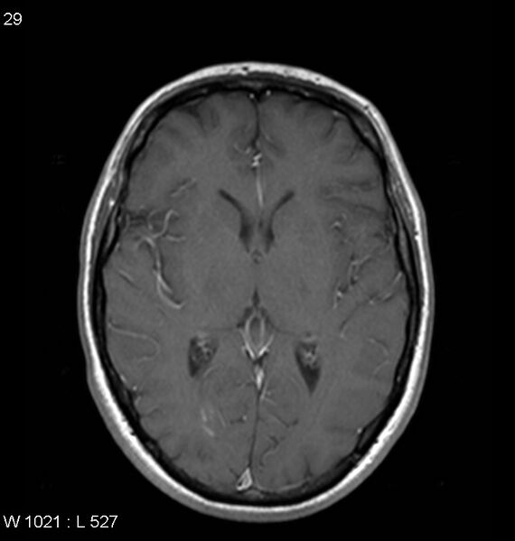 File:Neurosarcoidosis (Radiopaedia 10930-11351 Axial T1 C+ 10).jpg