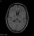 Neurosarcoidosis (Radiopaedia 10930-17204 Axial FLAIR 11).jpg