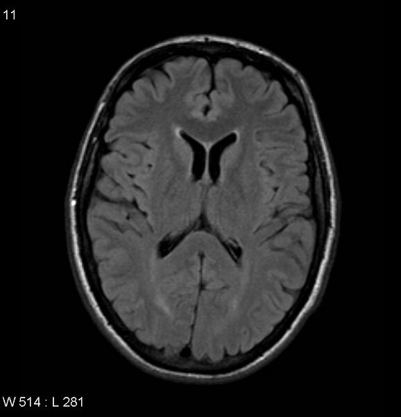 File:Neurosarcoidosis (Radiopaedia 10930-17204 Axial FLAIR 11).jpg