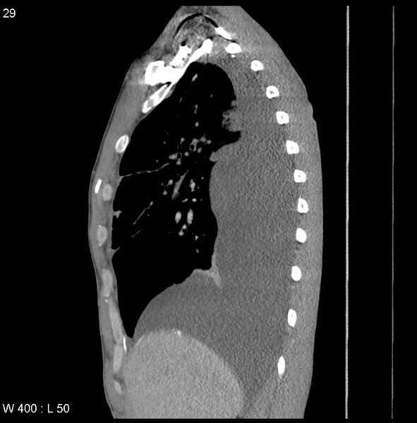 File:Non-Hodgkin lymphoma involving lung (Radiopaedia 29094-29470 D 20).jpg