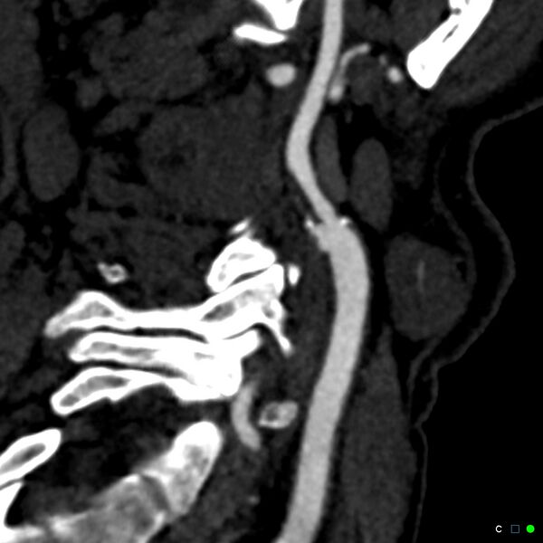File:Non-occlusive intraluminal internal carotid artery thrombus (Radiopaedia 37751-39658 C 12).jpg