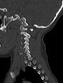 Normal CT cervical spine - pediatric (Radiopaedia 52549-58462 Sagittal bone window 168).jpg