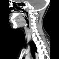Normal CT of the neck (Radiopaedia 14575-14500 Sagittal C+ 31).jpg
