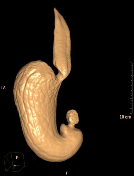 File:Normal CT virtual gastroscopy (Radiopaedia 29960-30501 3D VG 1).jpg