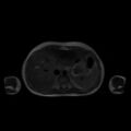 Normal MRI abdomen in pregnancy (Radiopaedia 88001-104541 Axial T2 10).jpg