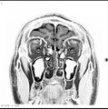 Normal coronal brain (Radiopaedia 6676-7910 B 3).jpg