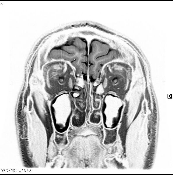 File:Normal coronal brain (Radiopaedia 6676-7910 B 3).jpg