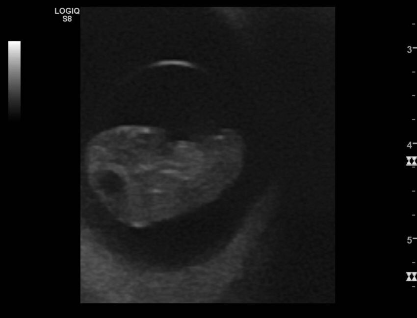 Normal early pregnancy - 8w0d (Radiopaedia 44715-48492 Longitudinal 24).jpg