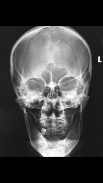 File:Normal facial bones (Radiopaedia 46261-50669 B 1).PNG