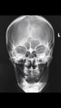 Normal facial bones (Radiopaedia 46261-50669 B 1).PNG