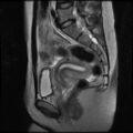 Normal female pelvis MRI (retroverted uterus) (Radiopaedia 61832-69933 Sagittal T2 19).jpg