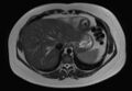 Normal liver MRI with Gadolinium (Radiopaedia 58913-66163 Axial T2 27).jpg