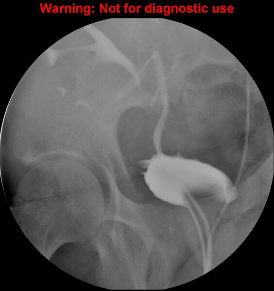 File:Normal retrograde pyelography of a native and transplant kidney (Radiopaedia 40480-43054 Transplant kidney 29).jpg