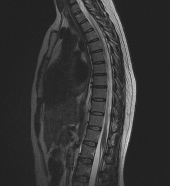 File:Normal thoracic spine MRI (Radiopaedia 41033-43781 Sagittal T2 8).jpg