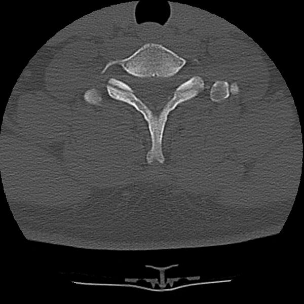 File:Normal trauma spine imaging (Radiopaedia 31753-32686 Axial bone window 68).jpg