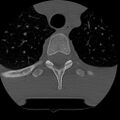 Normal trauma spine imaging (age 16) (Radiopaedia 45335-49358 Axial bone window 93).jpg