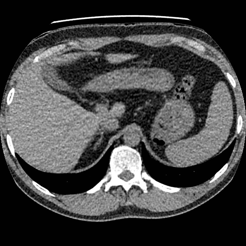 Obstructing ureteric calculus and ureteric anatomy (Radiopaedia 62730-71042 Axial non-contrast 1).jpg