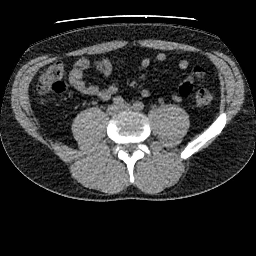 Obstructing ureteric calculus and ureteric anatomy (Radiopaedia 62730-71042 Axial non-contrast 90).jpg