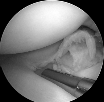 Degenerated and flap tear in anteromedial portion of complete discoid meniscus