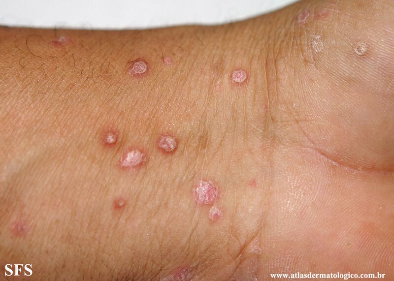 File:Psoriasis (Dermatology Atlas 127).jpg