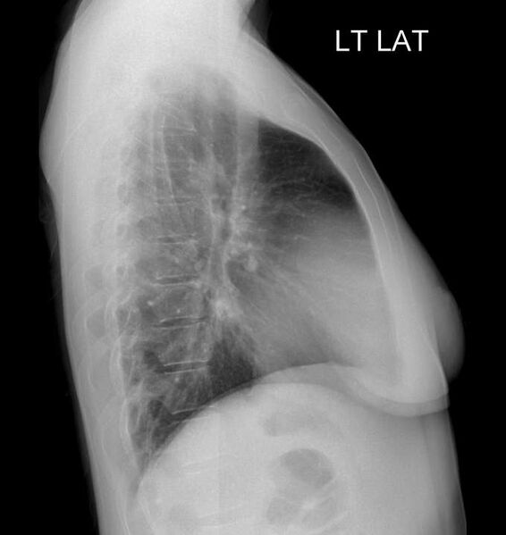 File:11 pairs of ribs and lumbosacral transitional vertebra (Radiopaedia 61880-69918 Lateral 1).jpg