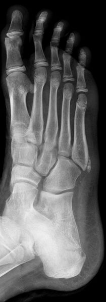 File:5th metatarsal fracture and normal apophysis (Radiopaedia 13196-13214 Oblique 1).jpg