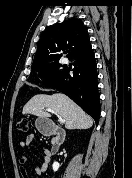 File:Abdominal aortic aneurysm (Radiopaedia 83094-97462 Sagittal renal cortical phase 48).jpg