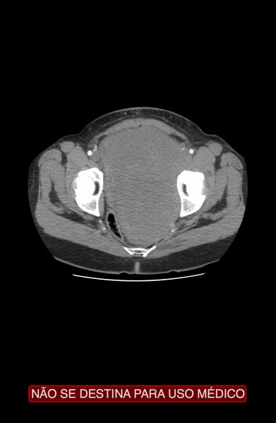 File:Abdominal desmoid tumor (Radiopaedia 44024-47540 Axial C+ arterial phase 48).jpg