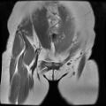Abdominal wall endometriosis (Radiopaedia 83702-98847 Coronal T1 2).jpg